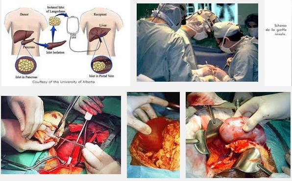 organu transplantacija